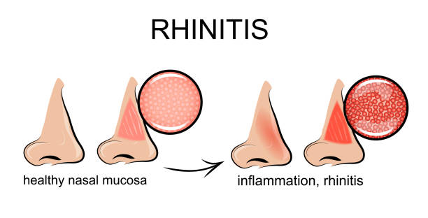 ilustrações, clipart, desenhos animados e ícones de rinite vasomotor da mucosa nasal. - snorting