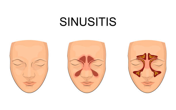 носовой пазухи. воспаление - ear exam stock illustrations