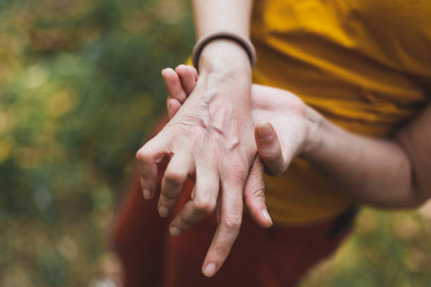 una foto de la mano de cerca con artritis afuera - artritis fotografías e imágenes de stock