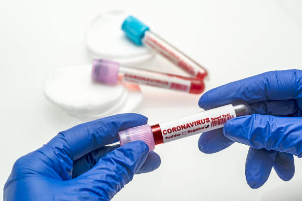 coronavirus blood test .  coronavirus negative blood in laboratory. - microbiology analyzing laboratory scrutiny imagens e fotografias de stock