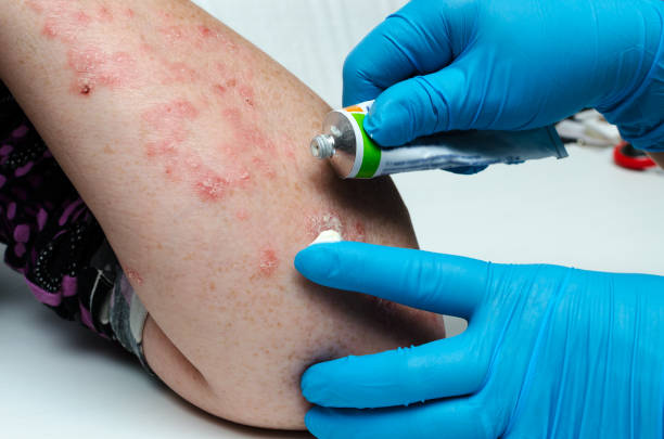 A dermatologist in gloves applies a therapeutic ointment to the affected skin of a patient with psoriasis. Treatment of chronic dermatoses - psoriasis, eczema, dermatitis. A dermatologist in gloves applies a therapeutic ointment to the affected skin of a patient with psoriasis. Treatment of chronic dermatoses - psoriasis, eczema, dermatitis ointment photos stock pictures, royalty-free photos & images