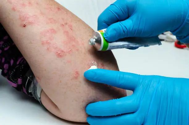 A dermatologist in gloves applies a therapeutic ointment to the affected skin of a patient with psoriasis. Treatment of chronic dermatoses - psoriasis, eczema, dermatitis