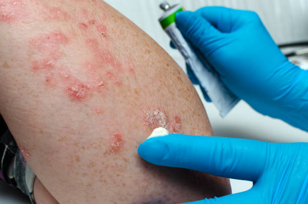 treatment of psoriasis. a gloved doctor applies a medicated ointment to a patient s diseased skin. - medicated imagens e fotografias de stock