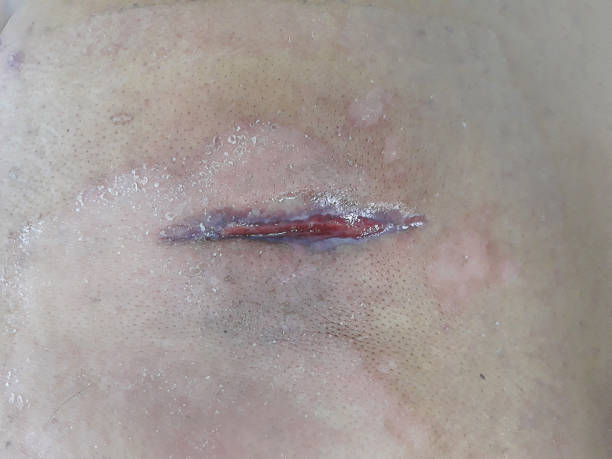 istock Surgical wound  large abscess with surrounding cellulitis. Huge upper back abscess require drainage in diabetic patient. 1205285041