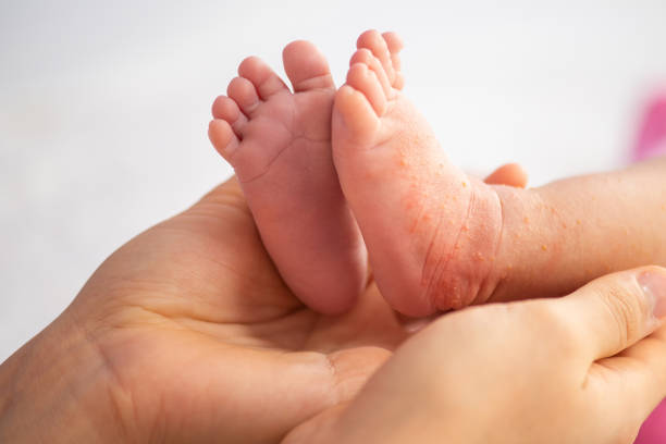 Infant legs with red dry skin. Suffering from allergy of milk formula or other food. Closeup.shot stock photo