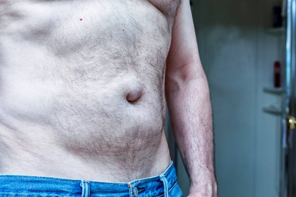 Webmd Bulging 100+ Male With Umbilical Hernia Stock Photos, Pictures & Royalty-Free ...