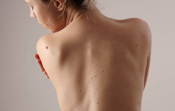 comprobación de lunares benignos : mujer con marcas de nacimiento en la espalda - piel partes del cuerpo fotos fotografías e imágenes de stock