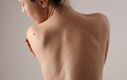 Checking benign moles : Woman with birthmarks on her back