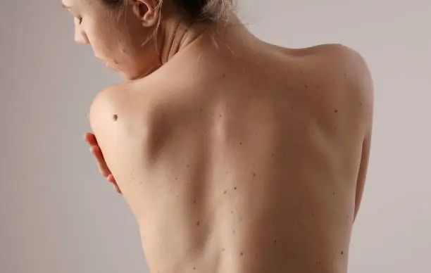 Photo of Checking benign moles : Woman with birthmarks on her back