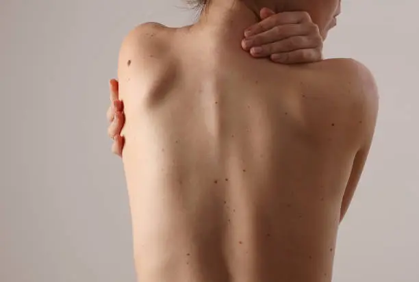 Photo of Checking benign moles : Woman with birthmarks on her back