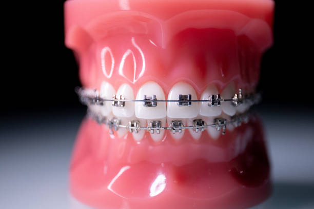 Close-up of teeth with metal braces. The jaw with braces turns on the surface. stock photo