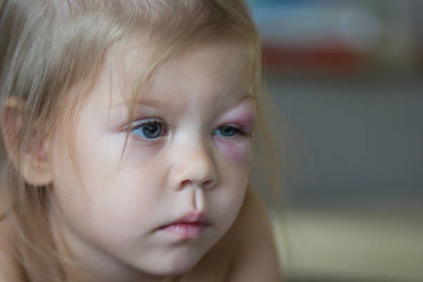 porträt von kaukasischem kind von zwei jahren mit der prellung im gesicht auf dem linken auge - discolored stock-fotos und bilder