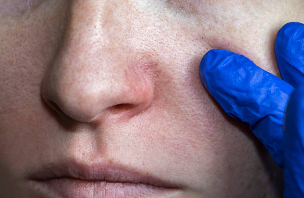 Cuperosis on the nose of a young woman. Acne on the face. Examination by a doctor Examination by a doctor. Cuperosis on the nose of a young woman. Acne on the face. hematoma images stock pictures, royalty-free photos & images