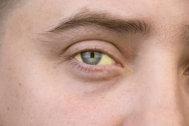 The yellow color of the male eye. Symptom of jaundice, hepatitis or problems with the gall bladder, gastrointestinal tract, liver. stock photo