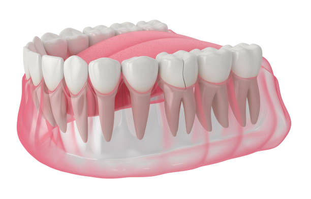 istock 3d render of jaw with cracked tooth 1205919642