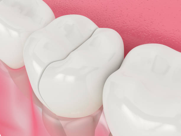 istock 3d render of jaw with cracked tooth 1205919666