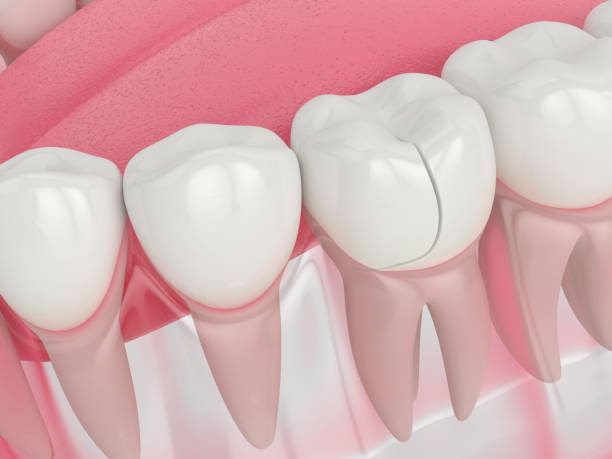 istock 3d render of jaw with fractured tooth 1205919682