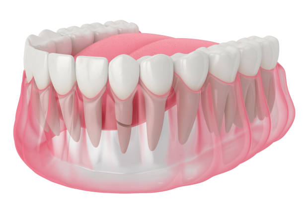 istock 3d render of jaw with cracked tooth root 1205919710