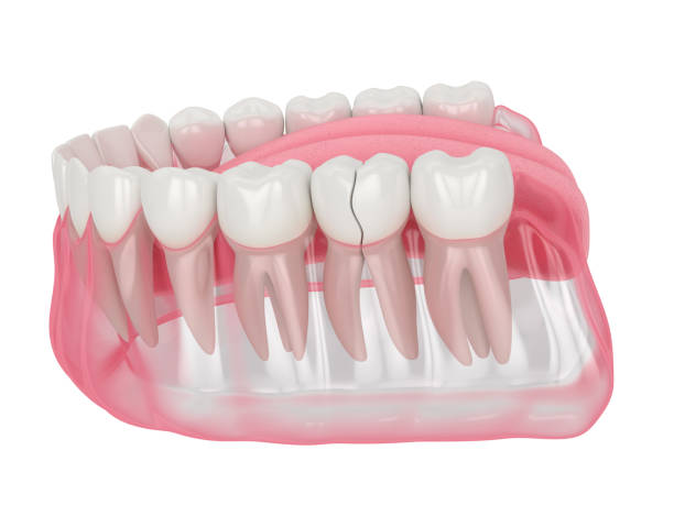 istock 3d render of jaw with cracked tooth 1205919713