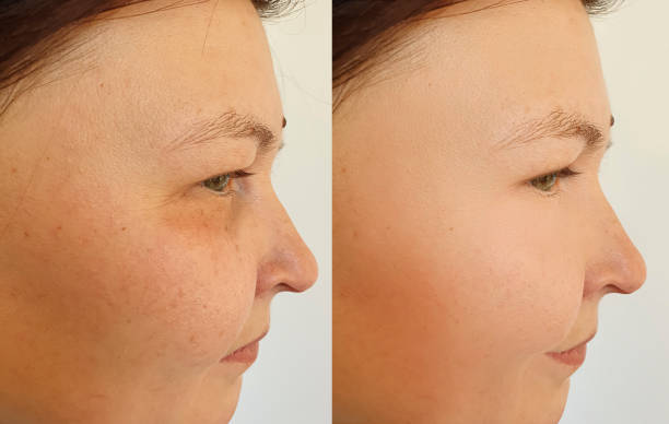 istock woman face wrinkles before and after treatment 1206256841