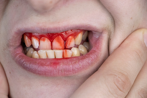 The Man Has Blood On His Teeth Severe Bleeding Of The Gums After A Blow