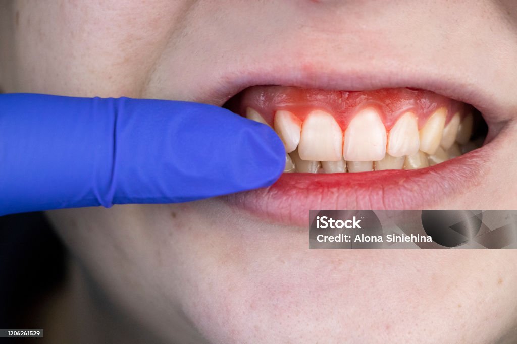 歯肉の出血と炎症が間近に迫る。歯科医の診察を受けた男性。歯肉炎の診断 - 歯のロイヤリティフリーストックフォト