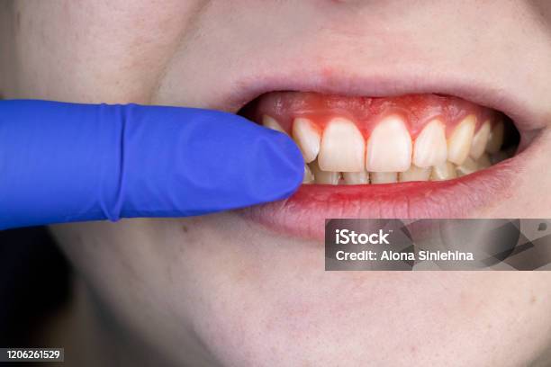 歯肉の出血と炎症が間近に迫る歯科医の診察を受けた男性歯肉炎の診断 - 歯のストックフォトや画像を多数ご用意 - 歯, プラーク, ヒトの歯茎