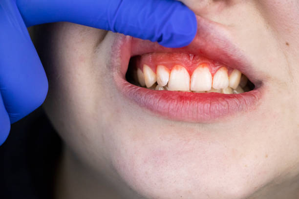 krwawienie z dziąseł i stan zapalny z bliska. mężczyzna przebadany przez dentystę. rozpoznanie zapalenia dziąseł - healthy gums obrazy zdjęcia i obrazy z banku zdjęć