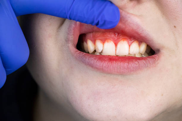 gum bleeding and inflammation close up. a man examined by a dentist. the diagnosis of gingivitis - gums imagens e fotografias de stock