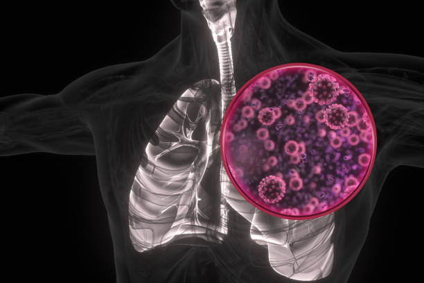 istock Pneumonia coronavirus x-ray lung illustration 1206362953