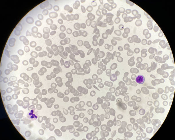 Blood smear of sickle cells and normal red and white blood cells Sickle cell trait is an inherited red blood cell disorder that affects millions of Americans and 8 to 10 percent of African Americans. anemia photos stock pictures, royalty-free photos & images