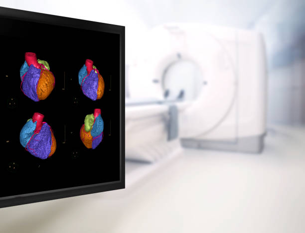 enfoque selectivo de la imagen de renderizado 3d de la arteria coronaria cta en el monitor. - tomografía fotografías e imágenes de stock