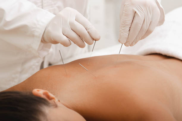 istock Acupuncturist punctures needle at special points on the back and is very accurate. Acupuncture close up. Traditional Chinese medicine 1206600590