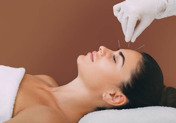 acupuncture treatment to relieve stress and relax the body. acupuncture is a traditional chinese medicine - massaging alternative medicine headache women imagens e fotografias de stock