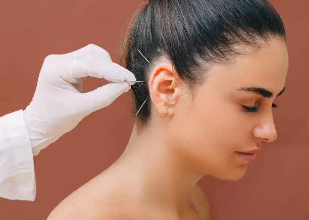 Acupuncturist treats a patients illness with acupuncture at special points on her ear. Acupuncture - alternative medicine