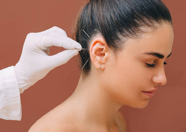 acupuncturist treats a patients illness with acupuncture at special points on her ear. acupuncture - alternative medicine - acupuncturist imagens e fotografias de stock