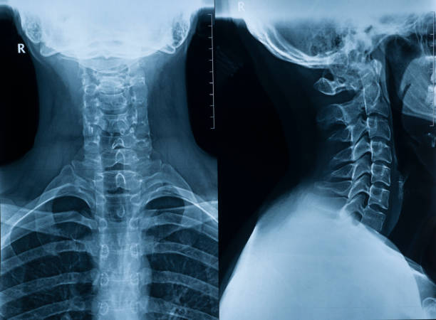 immagine a raggi x della colonna cervicale di un uomo in due proiezioni in piena vista e profilo - human lung x ray image x ray human spine foto e immagini stock