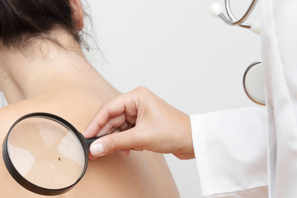 Skin Cancer Dermatologist examines skin cancer with a magnifier. mole skin stock pictures, royalty-free photos & images