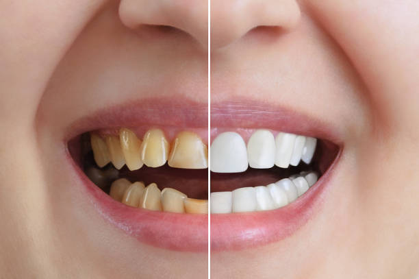 trattamento e sbiancamento dei denti, corone dentali. prima e dopo. odontoiatria. primo piano. - human teeth whitening dentist smiling foto e immagini stock