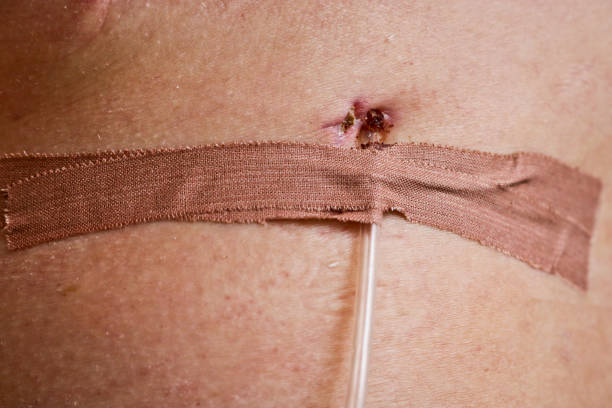 Lymphatic drainage duct in the wound. Postoperative removal of lymph to avoid edema. Lymphorrhea Lymphatic drainage duct in the wound. Postoperative removal of lymph to avoid edema. Lymphorrhea eschar stock pictures, royalty-free photos & images