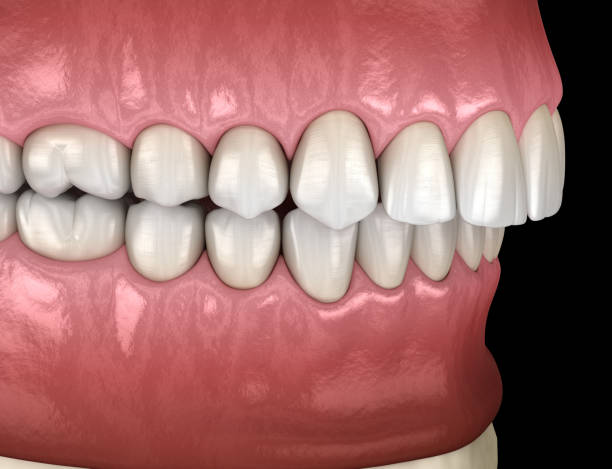 istock Overbite dental occlusion ( Malocclusion of teeth ). Medically accurate tooth 3D illustration 1206778239