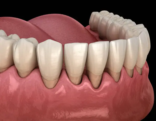 Photo of Gum recession process. Medically accurate 3D illustration