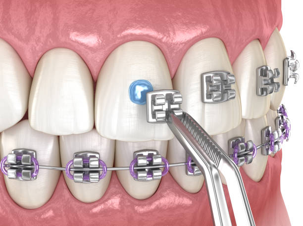 istock Metal braces installation process. Medically accurate dental 3D illustration 1206778356