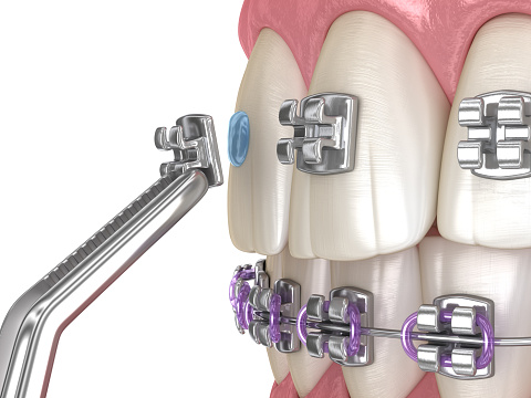 Proceso de instalación de llaves metálicas. Ilustración dental 3D médicamente precisa photo