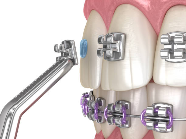 Metal braces installation process. Medically accurate dental 3D illustration