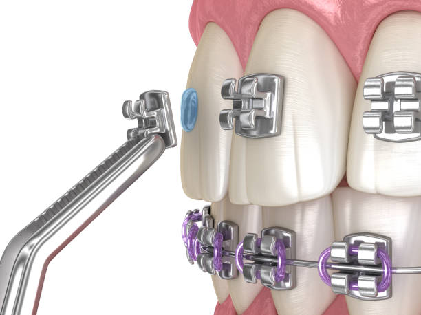 Medically accurate dental 3D illustration Metal braces installation process. - https://media.istockphoto.com/id/1206778358/photo/metal-braces-installation-process-medically-accurate-dental-3d-illustration.jpg?s=612x612&w=0&k=20&c=TZciY3WSWXPqEiKh0-Nh6Djc3TopnJ_LNqwcOyh4z2g=