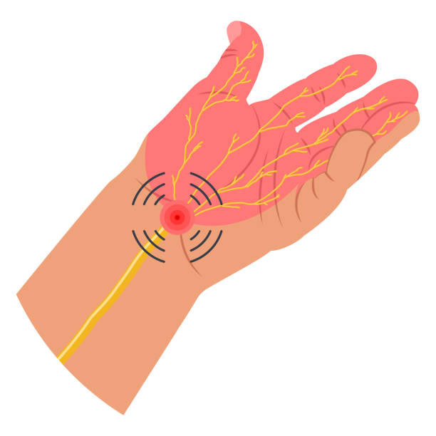 手根管症候群は、白い背景に単離された手の神経の痛みを伴う部分を持つ手首の医療イラストのベクター。 - anatomy human bone human muscle human hand点のイラスト素材／クリップアート素材／マンガ素材／アイコン素材