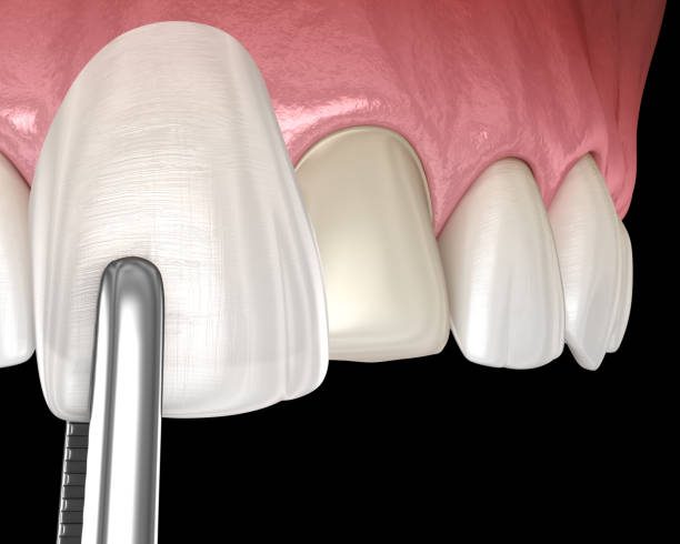 istock Dental Veneer installation procedure over central incisor. 3D illustration 1206835558