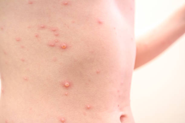 Child skin infected with chickenpox Child with virus of varicella has measles, chicken pox, rubella all over the body. Viral Diseases pox stock pictures, royalty-free photos & images