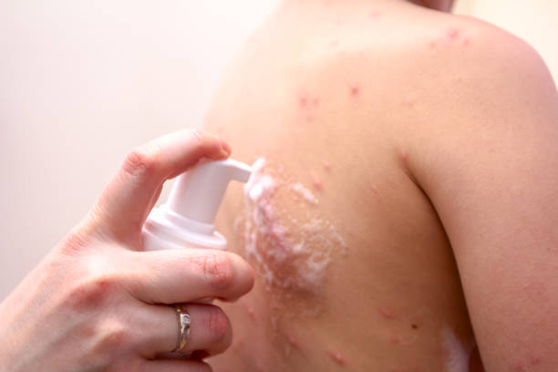 therapy against the virus of varicella has measles, chicken pox, rubella - lubrication infection imagens e fotografias de stock